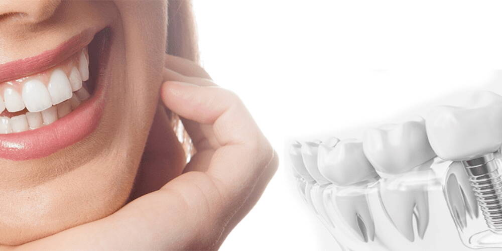 Zahnpflege – kosten implantate – in Luzern, Schweiz